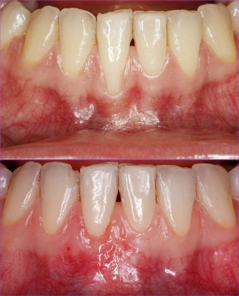 Gum Recession Treatment With Connective Tissue Transplant Dental