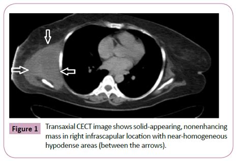 Imaging Of Elastofibroma A Rare Forgotten Tumor Of Chest Wall