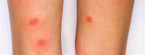 How To Get Rid Of Acne And Spots On Your Legs Holland And Barrett