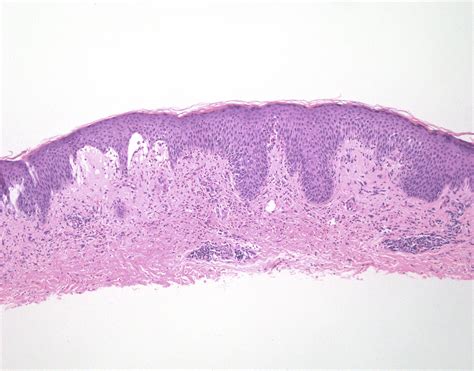 Pathology Outlines Bullous Pemphigoid