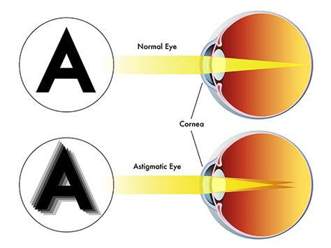 Astigmatism Vs Myopia What S The Difference