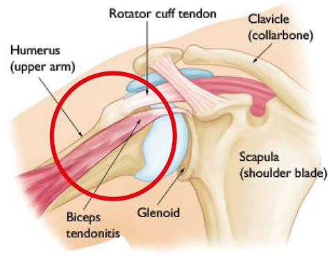Biceps Tendonitis Causes Symptoms Diagnosis Treatment How To Relief