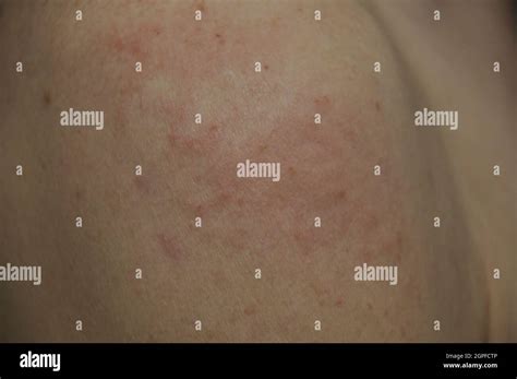 Eczema Pimples On A Shoulder Stock Photo Alamy