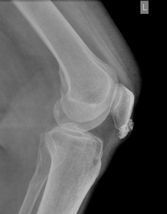 Trochanteric Bursitis X Ray