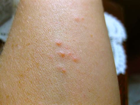 Pictures Of Baby Bed Bug Bites Get More Anythink S