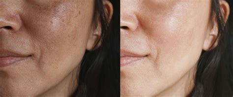 Melasma Treatment Best Dermatologist In Pune Skin Specialist