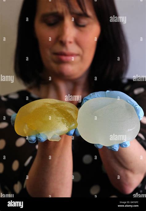 scottish pip implant victim jenny brown from edinburgh poses with her ruptured pip implants