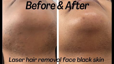 Before And After Laser Hair Removal For Black Skin Face Treatment Youtube