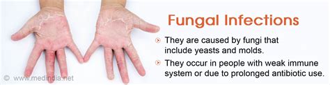 Fungal Infections Causes Symptoms Diagnosis Treatment And Prevention
