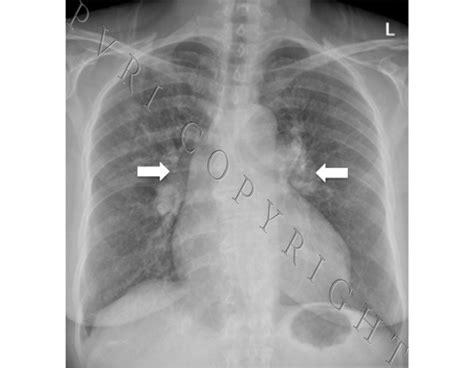 Chest Radiograph Of Cardiomegaly With Enlargement Of Proximal Pulmonary