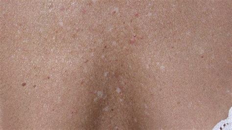 Vitamin Deficiency Small White Spots On Skin 5 Weird Signs That You