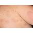 Urticaria  Stock Image C037/0863 Science Photo Library