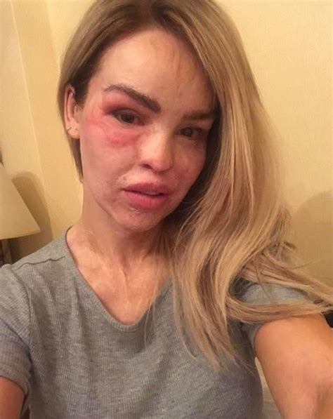 Katie Piper Leaves Hospital After Severe Eye Infection Daily Mail Online