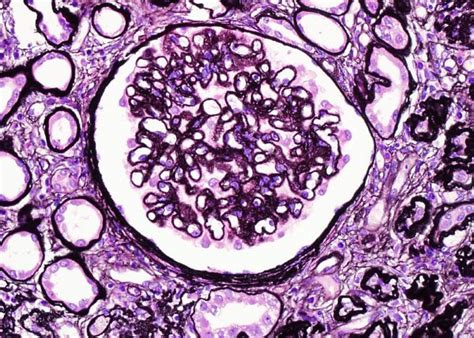Qiaos Pathology Membranous Glomerulonephritis A Photo On Flickriver