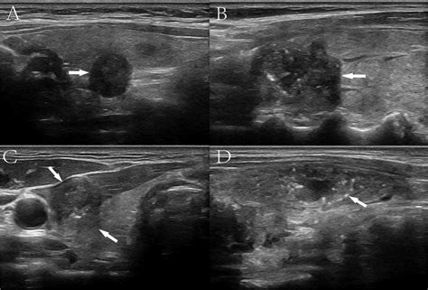 Ultrasound Features Significantly Associated With Malignant Thyroid