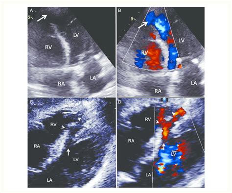Transthoracic Echocardiography Demonstrating A Simple Ventricular