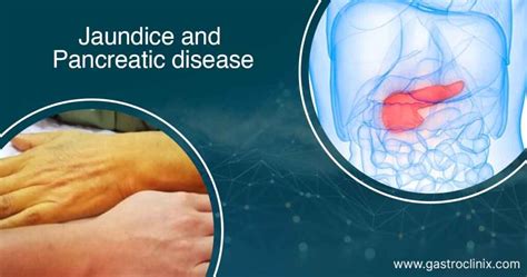 Jaundice In Pancreatic Diseases Dr Harsh J Shah