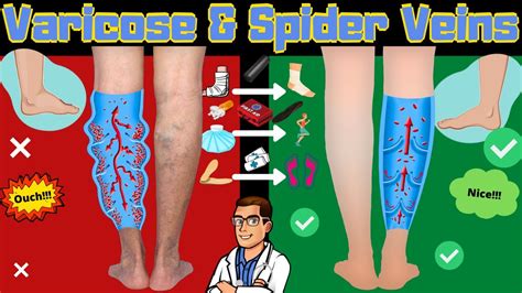 Spider Veins In Legs And Varicose Veins Treatment Causes And Symptoms