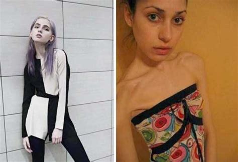 Shocking Pics Of Anorexic Girls KLYKER