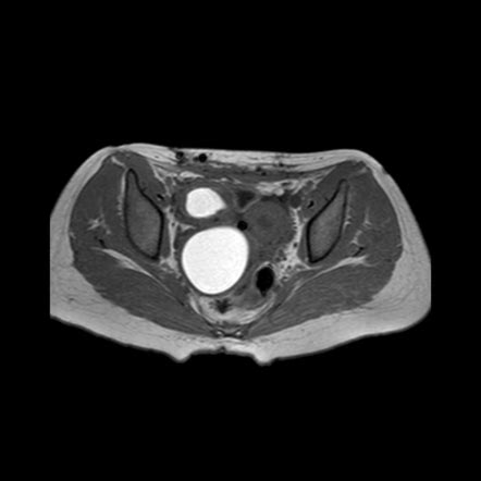 Imperforate Hymen Radiology Reference Article Radiopaedia Org