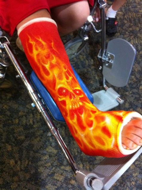 30 Creative Cast Designs That Prove You Can Still Look Cool With An