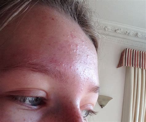 Mild To Moderate Forehead Acne General Acne Discussion Forum