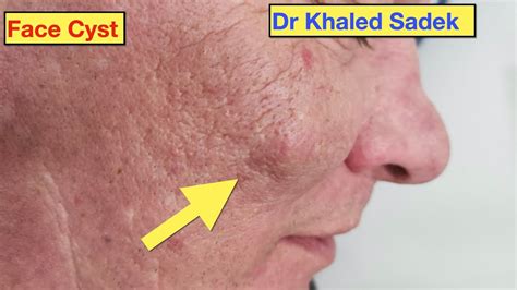 Cheeky Face Cyst Removal Dr Khaled Sadek LipomaCyst Com YouTube