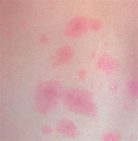 Hiv Rash Images Symptoms Location And Treatment Hubpages