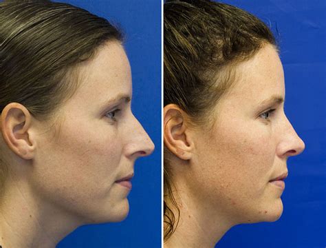 Pointy Nose Rhinoplasty Seattle Facial Plastic Surgeon Dr Lamperti