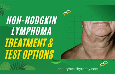 Best Non Hodgkin Lymphoma Treatment And Test Options