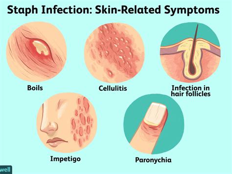 Why does beetlejuice even have that call his name three times caveat to wake him up? Staph infections - Symptoms and causes