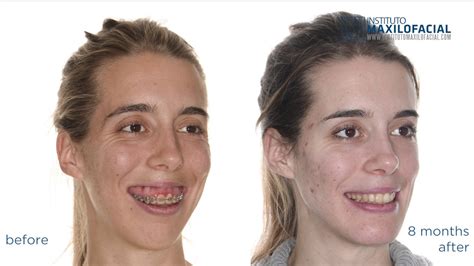 Marina Class Ii Gummy Smile Long Face Bimaxillary Surgery