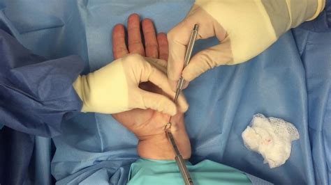 Hand Surgery Procedure Carpal Tunnel Syndrome Youtube