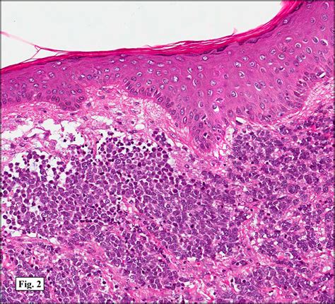 September 2011 A 76 Year Old Woman With A 7 Cm Mass In The Buttock