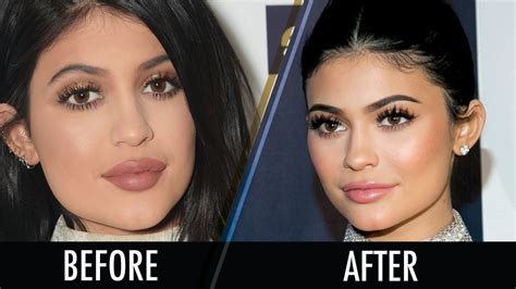 kylie jenner 2017 golden globes photos did she get plastic surgery lip filler reduction