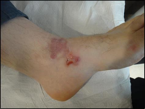 Figure 1 From Cutaneous Larva Migrans A Rare Tropical Dermatosis