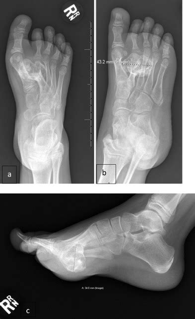 Solitary Plantar Metatarsal Osteochondroma Resulting In Altered Gait And Cavovarus Foot
