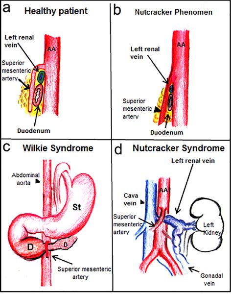 superior mesenteric artery syndrome wilkie syndrome with unusual clinical onset description