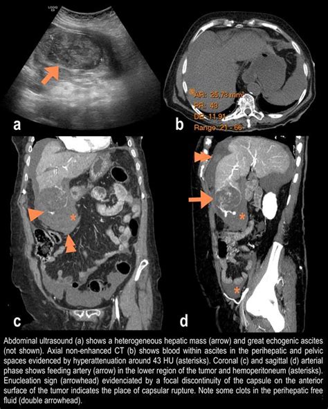 Hepatocellular Carcinoma Rupture As A Cause Of Spontaneous