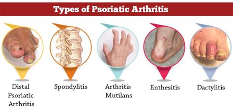 Psoriatic Arthritis Symptoms Pictures Pics Of Psoriatic Arthritis