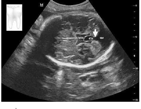 Diagnosis Of Joubert Syndrome Via Ultrasonography Semantic Scholar