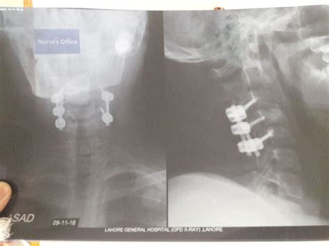 Cervical Spine Fixation Dr Zubair Mustafa Khan