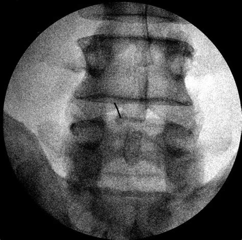 Difficult Lumbar Puncture Pitfalls And Tips From The Trenches