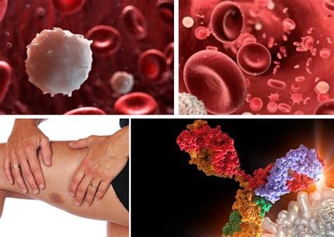 La leucemia è un tumore delle cellule del sangue che provoca anemia, infezioni ripetute, stanchezza, febbre e facilità a formare lividi. Leucemia: Causas, Síntomas Y Tratamiento - La Guía de las Vitaminas