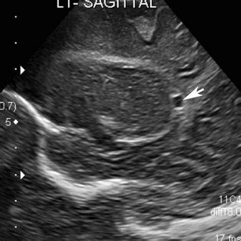 Normal Head Us In A Preterm In Sagittal Plane Through The Midline The
