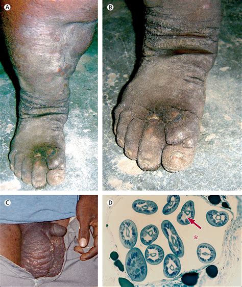 Lymphatic Filariasis And Onchocerciasis The Lancet