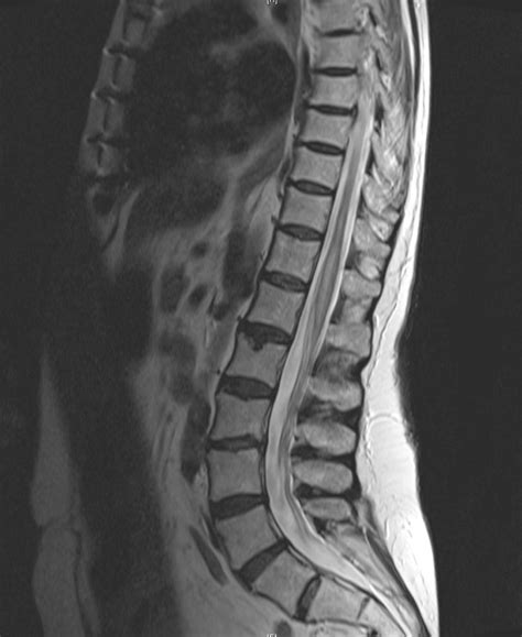 Sagittal T2 Weighted Mr Image Of The Thoracic And Lumbar Spine