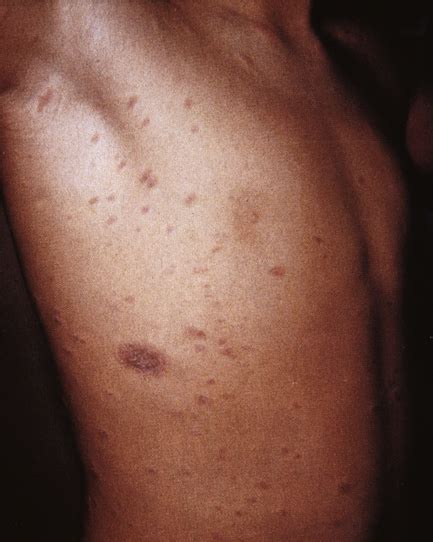 Pityriasis Rosea Herald Patch Fading Limiaccess