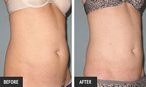 St Louis Cosmetic Surgery And Laser Lipo St Louis Liposuction Center