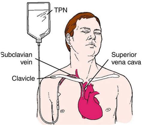 Total Parenteral Nutrition Tpn And Enteral Nutrition